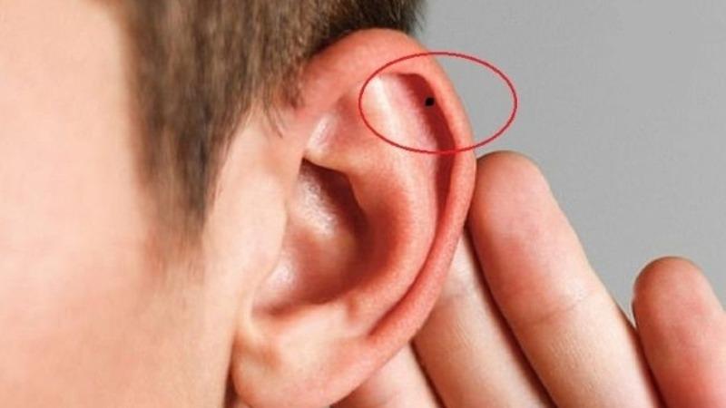giải mã Nốt ruồi ở tai